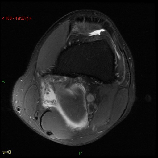 Figure 4 for case Medial head of gastrocnemius muscle ( RID2921 ) avulsion